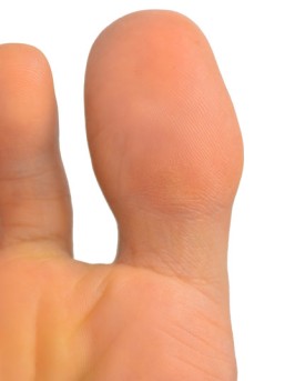 Arthroscopic Toe Joint Replacement by OrangeCountySurgeons